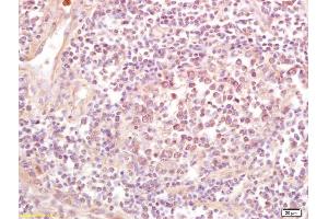 Formalin-fixed and paraffin embedded human lung carcinoma labeled with Rabbit Anti NDUFS1(75kD) Polyclonal Antibody, Unconjugated (ABIN750703) at 1:200 followed by conjugation to the secondary antibody and DAB staining (NDUFS1 antibody  (AA 51-150))