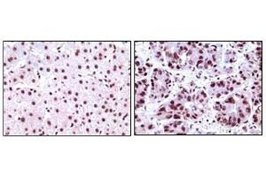 Immunohistochemical analysis of paraffin-embedded human liver carcinoma tissues, showing nuclear localization using NPM antibody with DAB staining. (NPM1 antibody)
