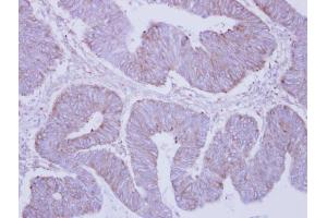 IHC-P Image Immunohistochemical analysis of paraffin-embedded human colon carcinoma, using PHKA2, antibody at 1:250 dilution. (PHKA2 antibody  (C-Term))