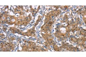 Immunohistochemistry of paraffin-embedded Human gastic cancer using CDC25A Polyclonal Antibody at dilution of 1:50 (CDC25A antibody)