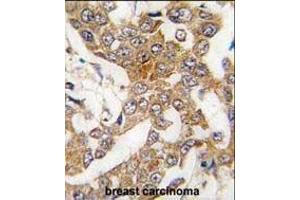 Formalin-fixed and paraffin-embedded human breast carcinoma tissue reacted with Bcl-w BH3 Domain Antibody (ABIN388097 and ABIN2846167) , which was peroxidase-conjugated to the secondary antibody, followed by DAB staining.