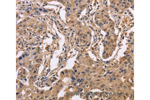 Immunohistochemistry of Human lung cancer using IDH1 Polyclonal Antibody at dilution of 1:50 (IDH1 antibody)