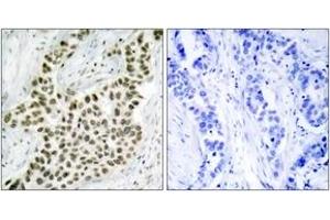 Immunohistochemistry analysis of paraffin-embedded human breast carcinoma tissue, using Histone H2A. (H2AFX antibody  (AA 94-143))