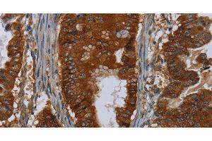 Immunohistochemistry of paraffin-embedded Human esophagus cancer using ERBB4 Polyclonal Antibody at dilution of 1:40 (ERBB4 antibody)