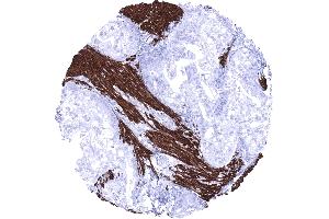 Stomach Gastric adenocarcinoma invading desmin positive smooth muscle fibres (Recombinant Desmin antibody)