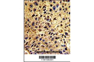 Formalin-fixed and paraffin-embedded human hepatocarcinoma with , which was peroxidase-conjugated to the secondary antibody, followed by DAB staining. (NUP62 antibody  (C-Term))