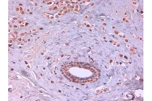Immunohistochemistry of Rat monoclonal anti AKT2 unconjugated Antibody in human breast carcinoma. (AKT2 antibody  (Internal Region) (FITC))