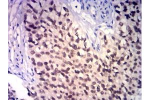 Immunohistochemical analysis of paraffin-embedded bladder cancer tissues using GATA3 mouse mAb with DAB staining. (GATA3 antibody)