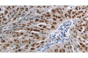 Immunohistochemistry of paraffin-embedded Human ovarian cancer using MCM3 Polyclonal Antibody at dilution of 1:30 (MCM3 antibody)