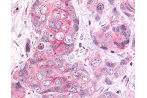 Anti-DUSP22 / JSP 1 antibody IHC of human Colon, Carcinoma. (DUSP22 antibody  (Internal Region))