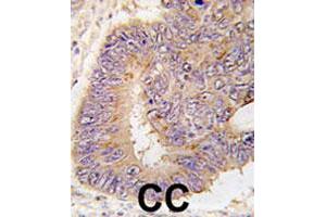 Formalin-fixed and paraffin-embedded human colon carcinoma tissue reacted with PDE8A polyclonal antibody  , which was peroxidase-conjugated to the secondary antibody, followed by DAB staining. (PDE8A antibody  (Leu572))