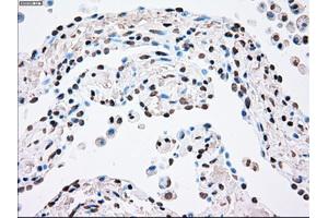 Immunohistochemical staining of paraffin-embedded Adenocarcinoma of breast tissue using anti-PLK1 mouse monoclonal antibody. (PLK1 antibody)
