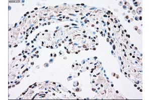 Immunohistochemical staining of paraffin-embedded Adenocarcinoma of breast tissue using anti-PLK1 mouse monoclonal antibody. (PLK1 antibody)