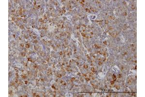Immunoperoxidase of monoclonal antibody to RAB8A on formalin-fixed paraffin-embedded human lymphoma. (RAB8A antibody  (AA 108-207))