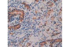 IHC-P analysis of Human Prostate Gland Cancer Tissue, with DAB staining. (Prolactin Receptor antibody  (AA 25-234))