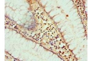 Immunohistochemistry of paraffin-embedded human colon cancer using ABIN7155290 at dilution of 1:100 (HAT1 antibody  (Catalytic Subunit))