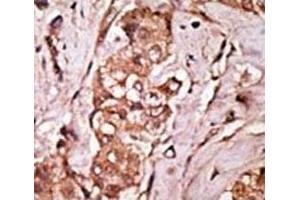 IHC analysis of FFPE human breast carcinoma tissue stained with the LRRK2 antibody (LRRK2 antibody  (AA 931-962))