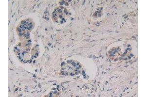 DAB staining on IHC-P; Samples: Human Breast cancer Tissue (MMP3 antibody  (AA 363-477))