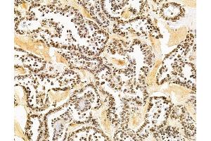 ABIN7095883 and ABIN7099945 at 1/100 staining human ovarian cancer by IHC-P. (PHRF1 antibody)