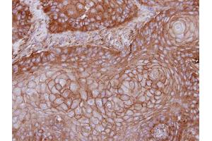 IHC-P Image Immunohistochemical analysis of paraffin-embedded Cal27 xenograft, using MPP1, antibody at 1:100 dilution. (MPP1 antibody  (Center))