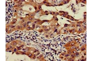Immunohistochemistry of paraffin-embedded human lung cancer using ABIN7165899 at dilution of 1:100 (OS9 antibody  (AA 232-413))