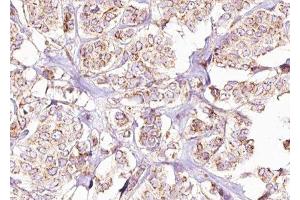 ABIN6275431 at 1/100 staining Human breast cancer tissue by IHC-P. (PDHA1 antibody  (C-Term))