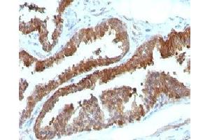 Formalin-fixed, paraffin-embedded human prostate carcinoma stained with HSP27 antibody (HSPB1/774)