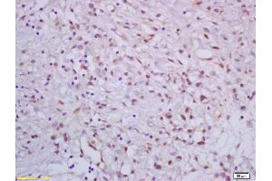 Formalin-fixed and paraffin embedded human gastric carcinoma labeled with Rabbit Anti APC70/CRSP70 Polyclonal Antibody, Unconjugated (ABIN1387561) at 1:200 followed by conjugation to the secondary antibody and DAB staining (CRSP Complex (AA 30-65) antibody)