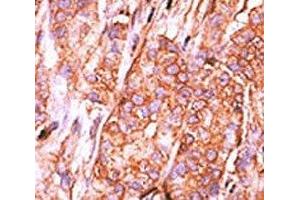 IHC analysis of FFPE human breast carcinoma tissue stained with the CTDSP2 antibody (CTDSP2 antibody  (AA 12-42))