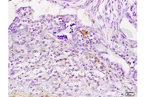 Formalin-fixed and paraffin embedded human breast carcinoma tissue labeled with Anti-Cathepsin H Polyclonal Antibody, Unconjugated (ABIN732758) at 1:200 followed by conjugation to the secondary antibody, (SP-0023), and DAB staining