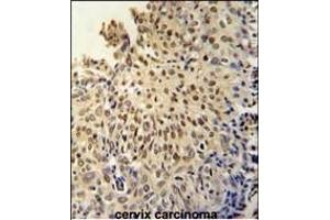 DI3L1 Antibody (N-term) (ABIN651802 and ABIN2840405) immunohistochemistry analysis in formalin fixed and paraffin embedded human cervix carcinoma followed by peroxidase conjugation of the secondary antibody and DAB staining.