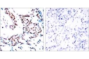 Immunohistochemistry analysis of paraffin-embedded human breast carcinoma tissue, using c-Jun (Ab-170) Antibody.
