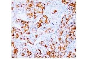 Immunohistochemical analysis of Paraffin Embeedded Mammary cancer sections using FGF2 antibody. (FGF2 antibody  (N-Term))