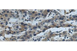 Immunohistochemistry of paraffin-embedded Human liver cancer tissue using CUL5 Polyclonal Antibody at dilution of 1:55(x200) (Cullin 5 antibody)
