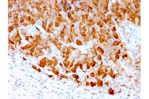 Formalin-fixed, paraffin-embedded human Melanoma stained with S100A1 Mouse Monoclonal Antibody (S100A1/1942).