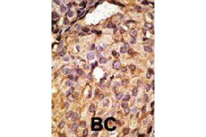 Formalin-fixed and paraffin-embedded human cancer tissue reacted with Tlr6 polyclonal antibody  , which was peroxidase-conjugated to the secondary antibody, followed by AEC staining. (TLR6 antibody  (C-Term))