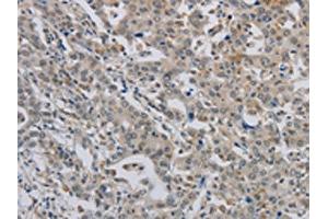 The image on the left is immunohistochemistry of paraffin-embedded Human liver cancer tissue using ABIN7189784(ALX4 Antibody) at dilution 1/20, on the right is treated with synthetic peptide. (ALX4 antibody)