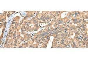 Immunohistochemistry of paraffin-embedded Human thyroid cancer tissue using FAM110B Polyclonal Antibody at dilution of 1:40(x200) (FAM110B antibody)
