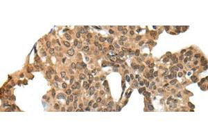 Immunohistochemistry of paraffin-embedded Human thyroid cancer tissue using APC Polyclonal Antibody at dilution of 1:45(x200) (APC antibody)