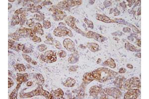 Immunohistochemistry of human breast carcinoma tissues were incubated with TPD52L1 monoclonal antibody , clone d1C5 (1 : 200)  at room temperature.