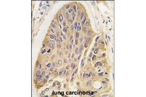 Formalin-fixed and paraffin-embedded human lung carcinoma tissue reacted with hMAP2-Q425 antibody, which was peroxidase-conjugated to the secondary antibody, followed by DAB staining. (MAP2 antibody  (C-Term))