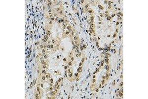 Immunohistochemical analysis of JUNB staining in human lung cancer formalin fixed paraffin embedded tissue section. (JunB antibody)