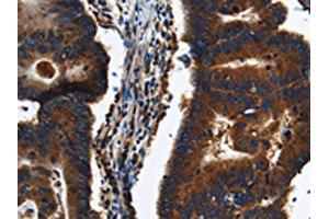 The image on the left is immunohistochemistry of paraffin-embedded Human colon cancer tissue using ABIN7191225(KLHL8 Antibody) at dilution 1/20, on the right is treated with synthetic peptide. (KLHL8 antibody)