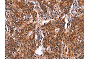 The image on the left is immunohistochemistry of paraffin-embedded Human gastric cancer tissue using ABIN7190641(FEM1A Antibody) at dilution 1/20, on the right is treated with synthetic peptide.