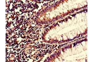 Immunohistochemistry of paraffin-embedded human colon cancer using ABIN7166034 at dilution of 1:100 (S1A1 (AA 2-97) antibody)