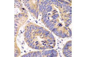 Immunohistochemistry of paraffin-embedded human colon carcinoma using HMGCL antibody. (HMGCL antibody  (AA 1-325))