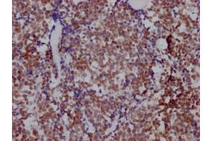 IHC image of ABIN7127539 diluted at 1:100 and staining in paraffin-embedded human lung cancer performed on a Leica BondTM system. (Recombinant HDAC3 antibody)