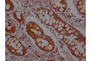 IHC image of ABIN7127629 diluted at 1:100 and staining in paraffin-embedded human colon cancer performed on a Leica BondTM system. (Recombinant SLC16A1 antibody)