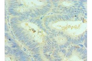 Immunohistochemistry of paraffin-embedded human colon cancer using ABIN7147590 at dilution of 1:100 (CLIC4 antibody  (AA 1-253))