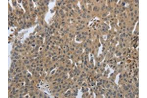 The image on the left is immunohistochemistry of paraffin-embedded Human ovarian cancer tissue using ABIN7192074(PTPRT Antibody) at dilution 1/30, on the right is treated with synthetic peptide. (PTPRT antibody)